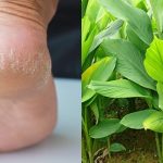 Cracked heel home remedy